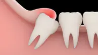 باکشیدن دندان عقل ، عملکردحس چشایی بهبود میابد