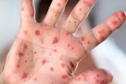 ابتلای ۹۶ نفر به سرخک در کشور | وزارت بهداشت: تزریق واکسن ضروری است