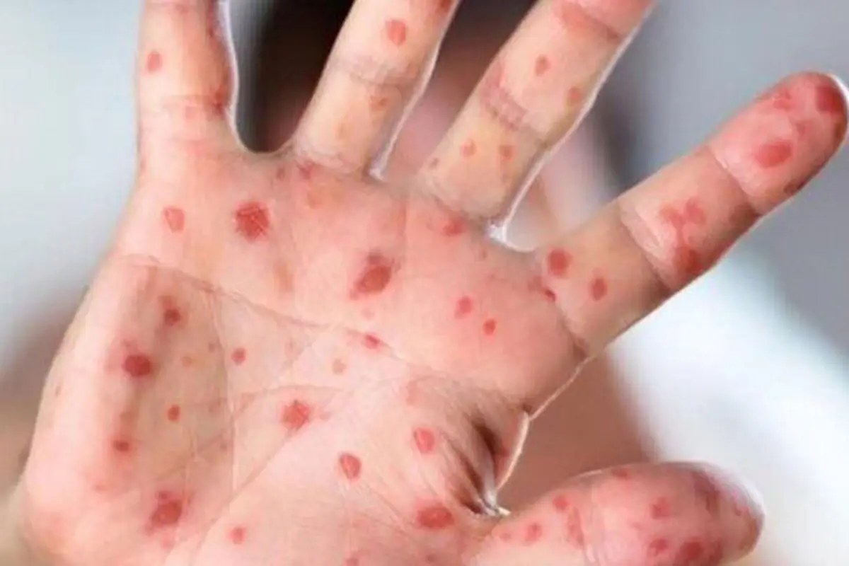 ابتلای ۹۶ نفر به سرخک در کشور | وزارت بهداشت: تزریق واکسن ضروری است