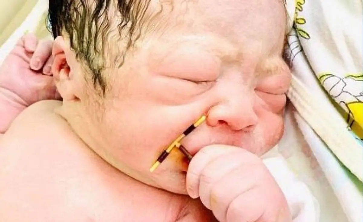 نوزادی به همراه آی‌یودی عمل نکرده مادرش متولد شد