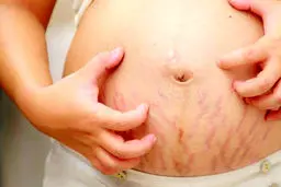 به سفیده تخم مرغ به راحتی ترک های شکمت را از بین ببر | ترفندی سنتی اما کار ساز