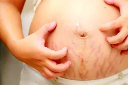 به سفیده تخم مرغ به راحتی ترک های شکمت را از بین ببر | ترفندی سنتی اما کار ساز