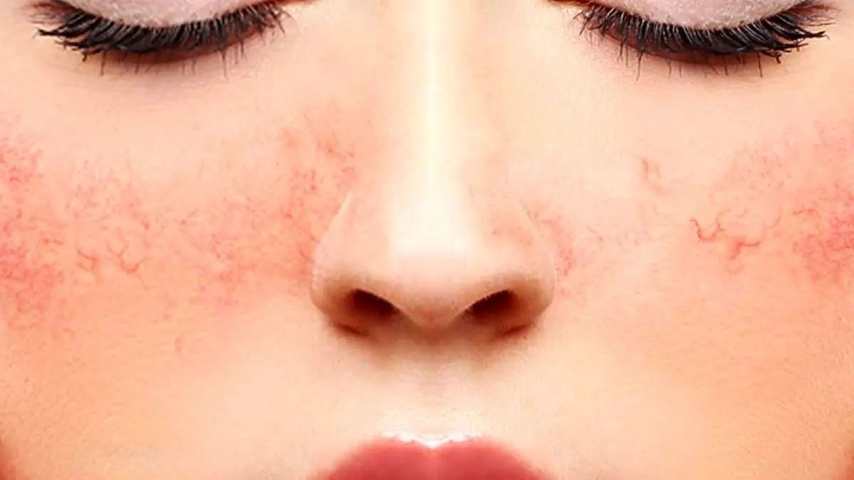 راهنمای جامع مراقبت از پوست های حساس | نکات و راهکارهای مفید برای پوست مشکل‌دار