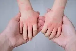 علت خشکی پوست در کودکان | هشدارهای مهم یک متخصص برای والدین +ویدئو