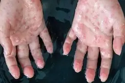 آبله میمون در یک قدمی ایران | چکار کنیم بعد از کرونا آبله میمون نگیریم؟