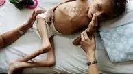  ۳۰ درصد کودکان دنیا از سوءتغذیه شدید رنج می برند