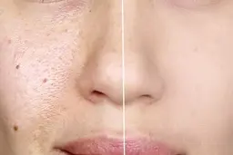 عادتهای اشتباه که می تواند باعث جوش زدن پوست صورت  شود