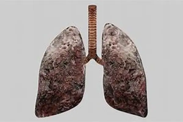 فیلمی از وضعیت اسفناک ریه فردی که به مدت ۳۰ سال یک پاکت سیگار کشیده بود  | مراقب سلامتی خود باشید+ ویدئو