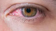 بیماری چشم صورتی چیست؟ با درمان خانگی این بیماری آشنا شوید