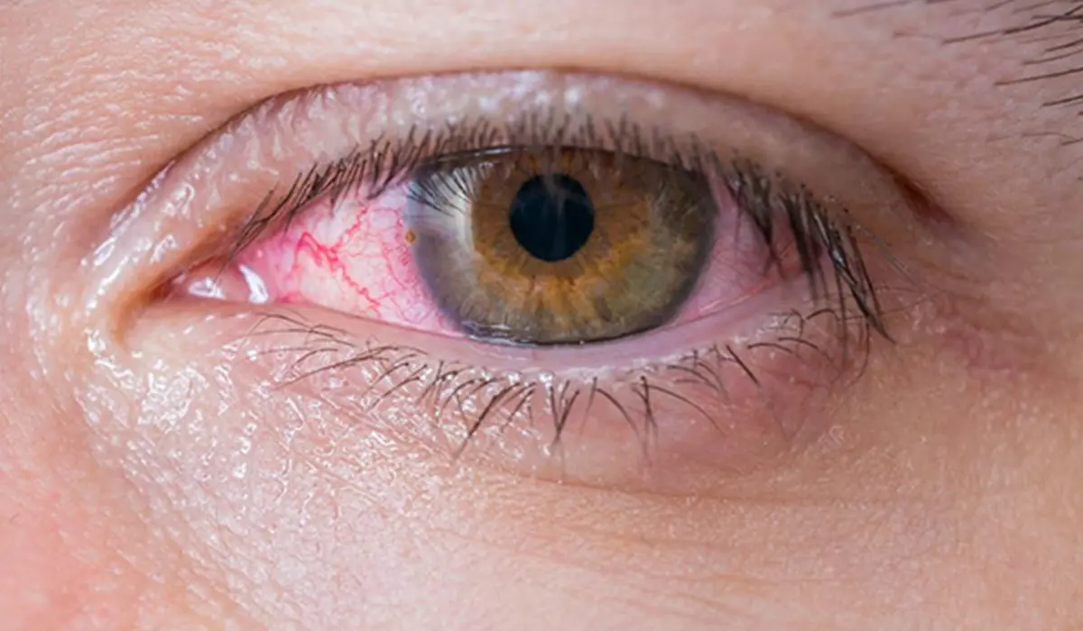 بیماری چشم صورتی چیست؟ با درمان خانگی این بیماری آشنا شوید