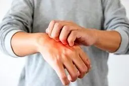بیماری هایی که خود را با خارش پوست نشان می دهند