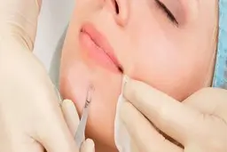 دلیل جوش های سرسیاه چیست؟