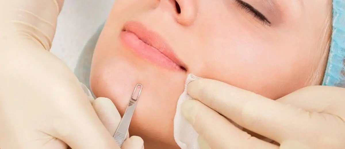 دلیل جوش های سرسیاه چیست؟