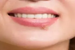 بررسی عوامل به وجود آمدن تبخال | روش درمان سریع تبخال