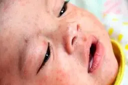 علائمی که نشانه ابتلا به سرخک است + جزئیات 