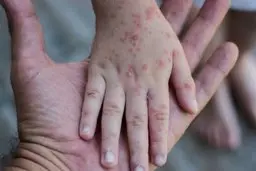 نشانه‌های سرخک را بشناسید