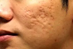درمان جوش صورت با این روش ساده |نکته مهم در مصرف راکوتان