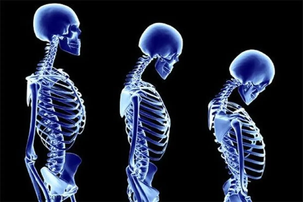 کاهش قد در میانسالی زنان، باعث مرگ زودرس می‌شود
