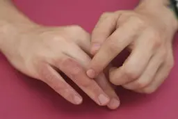 درمان فوری سوختگی با آب جوش با یک راه‌کار ساده و خانگی+ ویدیو 