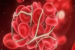 ارتباط لخته‌های خونی کوچک با کووید-۱۹