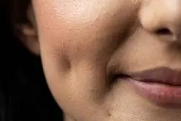 عمل چال گونه چیست و چه عوارضی دارد؟ 