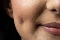 عمل چال گونه چیست و چه عوارضی دارد؟ 