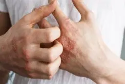 اگزما و دلیل به وجود آمدن آن چیست؟ | درمان خانگی بیماری اگزما و راه های پیشگیری از آن