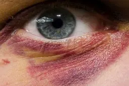 اگر کبود شده اید بخوانید| دیه کبودی اعضای بدن چند؟ 