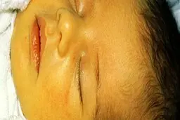 تاثیر تغذیه با شیر مادر بر فشار خون کودک 
