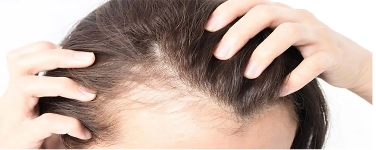 دلیل ریزش مو در نوجوانی چیست؟ |  راهکارهایی را برای درمان ریزش مو در نوجوانی