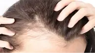 دلیل ریزش مو در نوجوانی چیست؟ |  راهکارهایی را برای درمان ریزش مو در نوجوانی