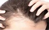 دلیل ریزش مو در نوجوانی چیست؟ |  راهکارهایی را برای درمان ریزش مو در نوجوانی