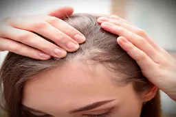 با این ترفندها با شوره سر خدافظی کن | روشهای کاربردی برای از بین بردن شوره سر 