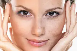 لک صورت را با این روش محو کنید | درمان لک صورت