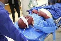هنگام برخورد با مصدومان سوختگی باید چند اقدام را انجام دهید.
