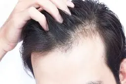 هشدار؛ افزایش خطر ریزش مو با آیا غذا‌ها می‌توانند باعث ریزش مو شوند؟
خوردن این غذاها