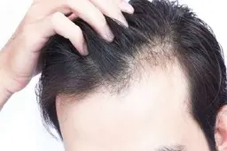 هشدار؛ افزایش خطر ریزش مو با آیا غذا‌ها می‌توانند باعث ریزش مو شوند؟
خوردن این غذاها