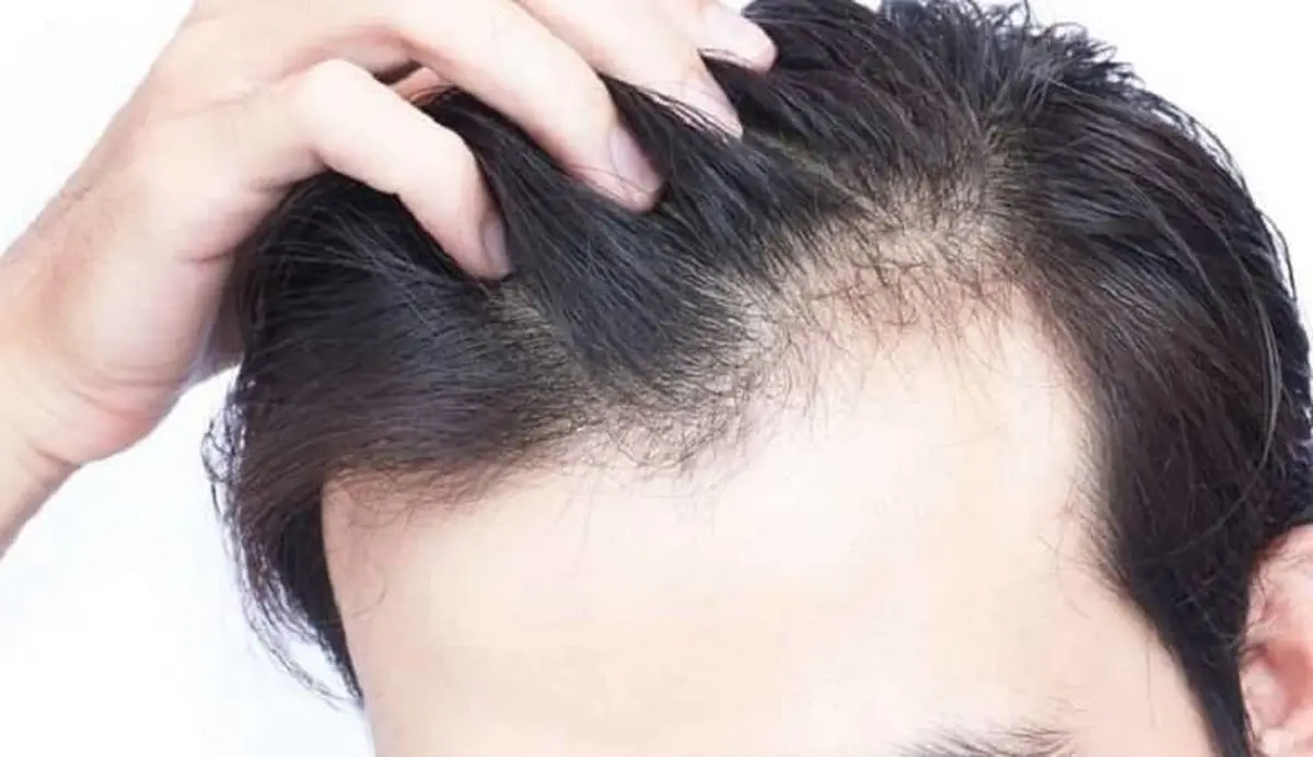 هشدار؛ افزایش خطر ریزش مو با آیا غذا‌ها می‌توانند باعث ریزش مو شوند؟
خوردن این غذاها