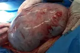عمل جراحی |  توده 22 کیلوگرمی از شکم یک بیمار خارج شد