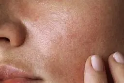 با این ترفند دیگه از شر چربی پوستت خلاص میشی | خداحافظی با پوست چرب با این ترفند ساده! +ویدئو