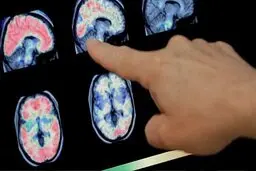 تمام عوارض نورولوژیک کرونا|خیلی مواظب اعصابتان باشید