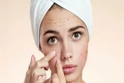 روش خانگی و طبیعی برای درمان آکنه
