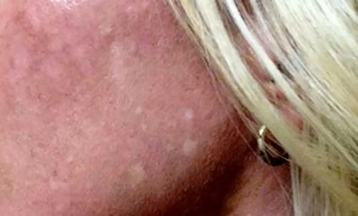 لکه های سفید روی پوست نشانه چیست؟ 
