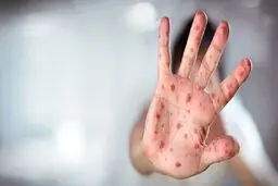 ابتلای یک کودک ۹ ماهه به سرخک در قم