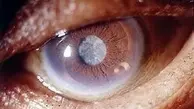 اثر کرونا به «چشم» چگونه است؟ 