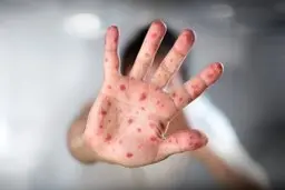 هشدار وزارت بهداشت درباره شیوع سرخک |  فراخوان واکسیناسیون کودکان ایرانی و مهاجر زیر ۵ سال