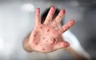 هشدار وزارت بهداشت درباره شیوع سرخک |  فراخوان واکسیناسیون کودکان ایرانی و مهاجر زیر ۵ سال