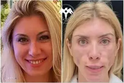 این مدل معروف با جراحی پلاستیک ناموفق تمام صورت خودشو فلج کرد! | باید با چشمای باز بخوابه و با دهن بسته بخنده! + عکس