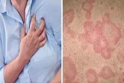 آیا ضایعه پوستی نشانه بیماری قلبی است ؟