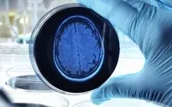 دانشمندان علت پیشرفت آلزایمر در مغز را کشف کردند